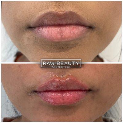 Lip Filler Definition. Minimal Volume Change, Just High Definition Lip Contouring, with a little added Height!