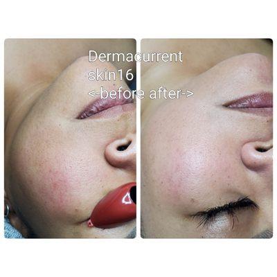 Texture? Discoloration? All in one facial