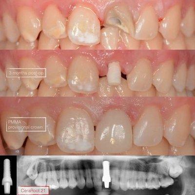 CeraRoot  Zirconia Implants - Holistic Dentistry