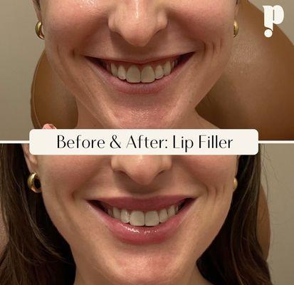 Lip Filler by Felisha J.