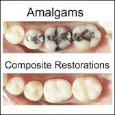 Change old silver fillings to White natural looking fillings!!