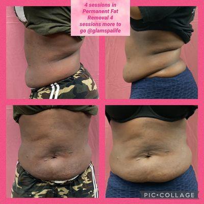 4 to 12 sessions of fat burning and permanent non invasive removal treatments