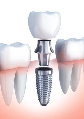 Implant parts from bottom to top; implant, abutment and crown.