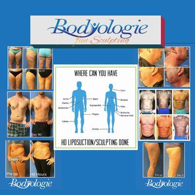 APMR Now Offering Bodyologie Fun Sculpting a Body Contouring Procedure.  Call Today to Schedule a FREE Consultation