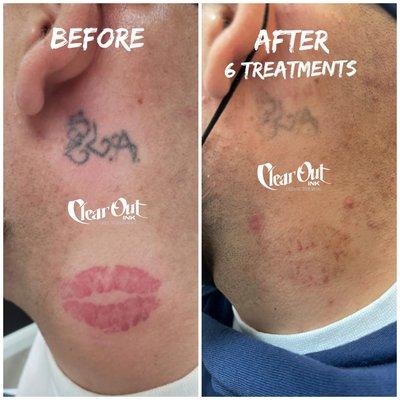 Great results after just 6 treatments. Book Now 702-366-5247