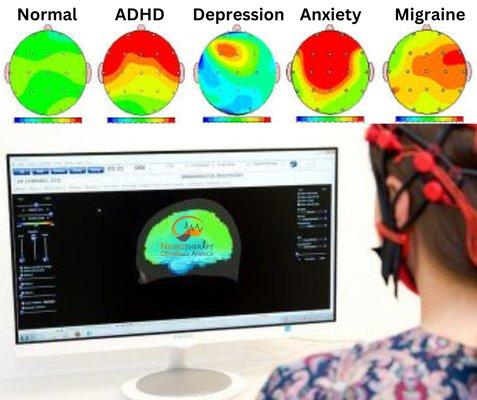 Brain Mapping for ADHD, Anxiety, Depression, and Migraine