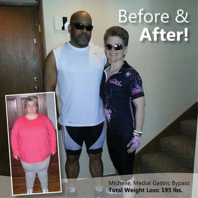 Michelle lost 195 lbs. after having the Medial Gastric Bypass with Dr. Srikanth.