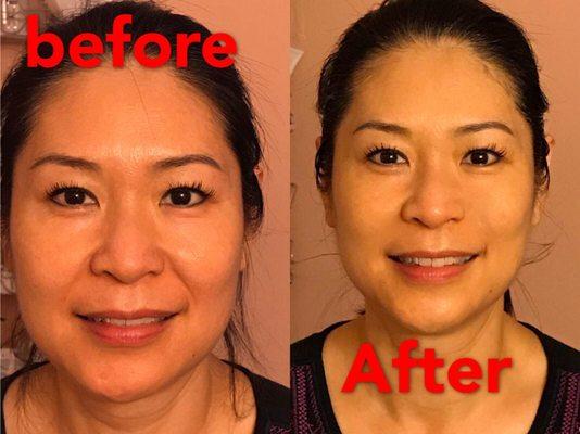 Result after 1 treatment