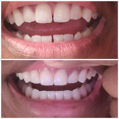 Before and after my invisalign treatment