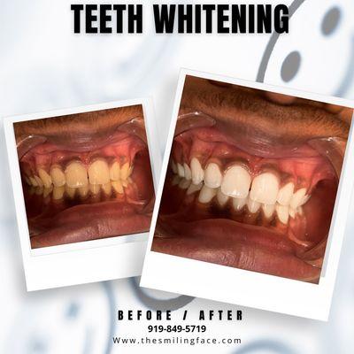 Professional Teeth Whitening