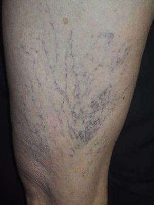 spider veins before treatment