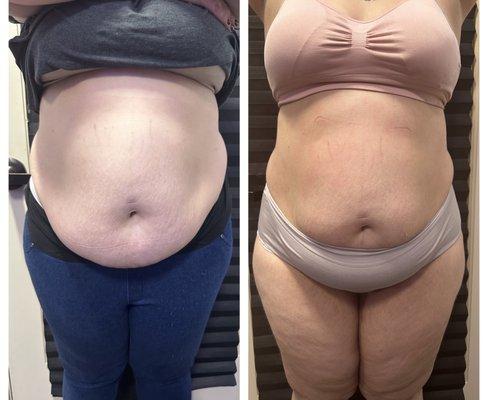 Mommy make over treatment! Instant fat removal while tightening and toning the skin with zero downtime!