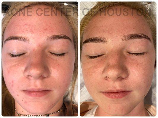 Get clear with the Acne Center of Houston program.