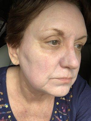 After 1st vascular IPL (59.5 years old) for rosacea/pores/broken capillaries