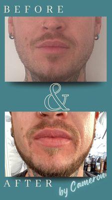 Lip enhancement with Restylane