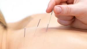 Acupuncture is really working for your pains.