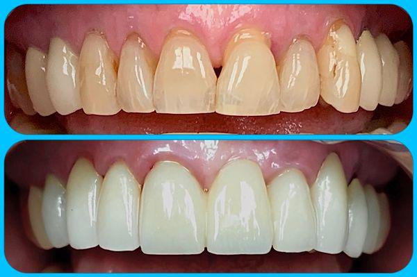 Smile transformation by Dr Eric Lin DDS