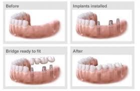 Implant Restoration