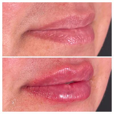 Lip Filler Before + After