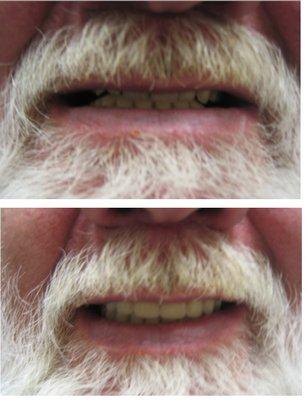 Full Upper & Lower Dentures