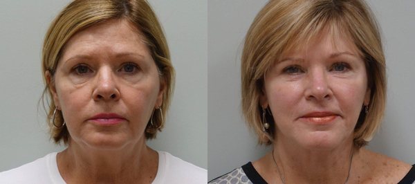 Before and after Face Lift and Blepharoplasty.