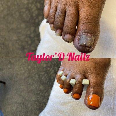 Toenail Restoration