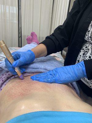 Microneedling for stretch mark on my tummy