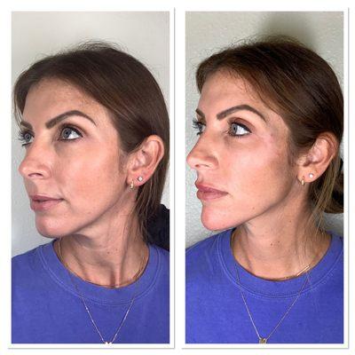 Botox, Jawline, Cheek and Lip Filler