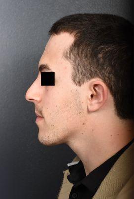 Before rhinoplasty and chin procedure