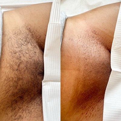 Before & after Brazilian wax