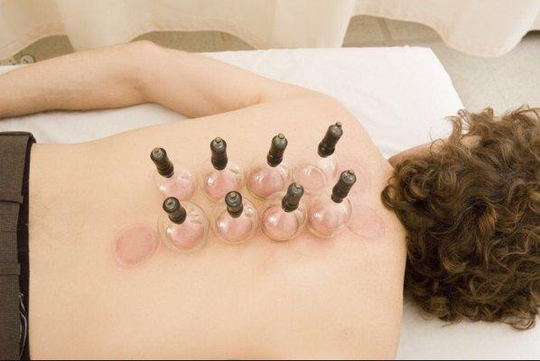 Cupping massage:60minutes Deep tissue or Swedish massage with cupping $98(now $65)