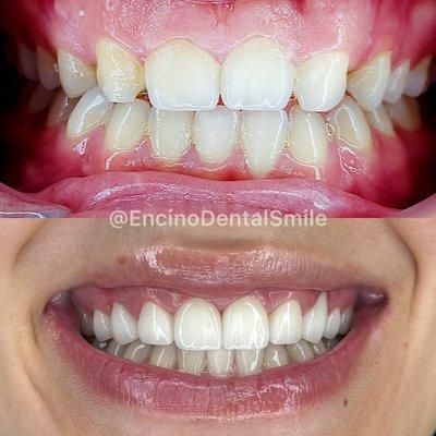 Upper natural smile makeover with gum lift