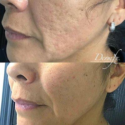 2 sessions of microneedling with PRF