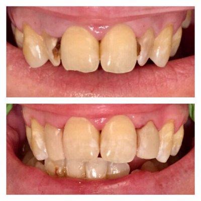 We helped this patient on the same day by removing decay and bonding new material to her teeth!