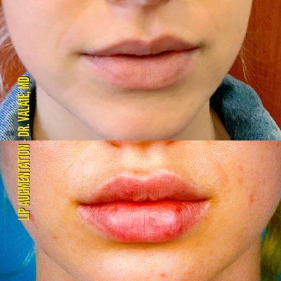 Lip Augmentation - Dr.Valaie, MD