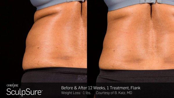 Sculpsure(R) is a  breakthrough treatment that takes only 25 minutes and is extremely safe & more effective than Coolsculpting.