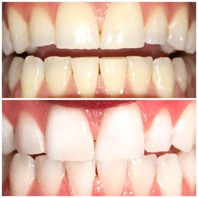 I'm literally SO IMPRESSED with this aurora organic teeth whitening ! Definitely worth it