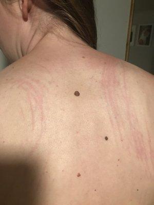 The scratches on my back from the masseuse