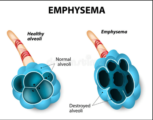 THE LUNGS IN EMPHYSEMA