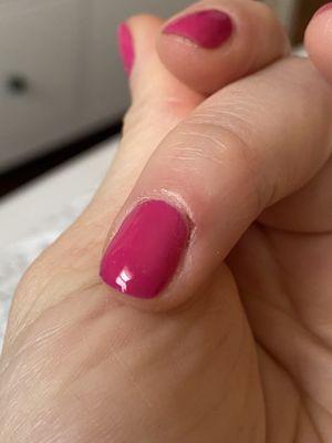 Bleeding cuticle