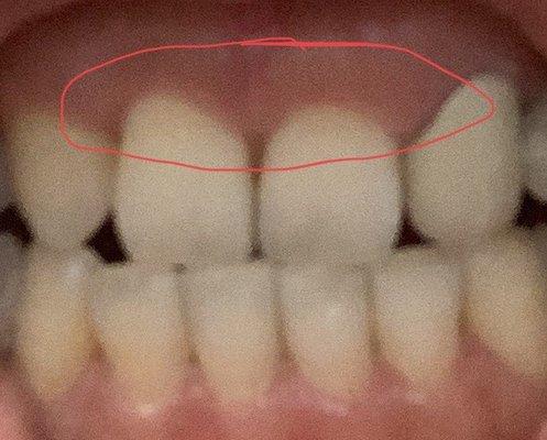 After procedure, uneven gum line