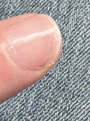 Cuticles ripped up and not removed, jagged nail