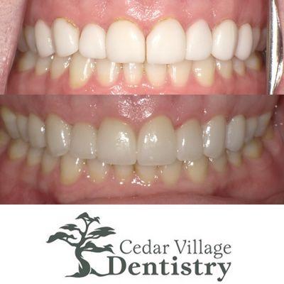 Smile Transformation Before and After- Dr. Thomas Dooley Cedar Village Dentistry