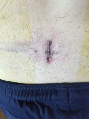 1 inch incision