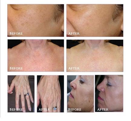 Laser Genesis for redness, skin texture, pore reduction, collagen stimulation and fine line reduction.