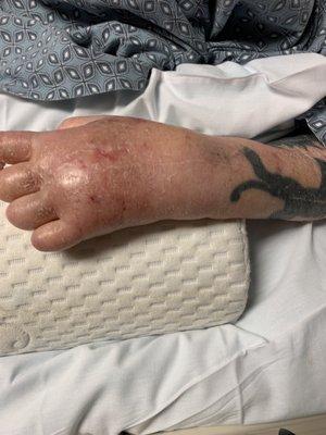 Hand swollen and not being addressed I placed a pillow under it