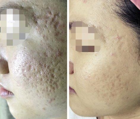 Acne scar treatment with Micro-needling