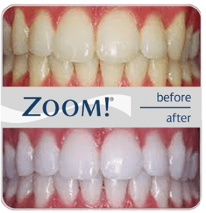 Zoom in office whitening