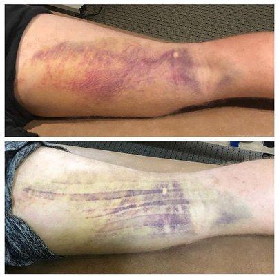 Before and after kinematic taping for hamstring tear to reduce swelling and bruising.