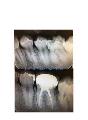 Root canal, build up and crown.